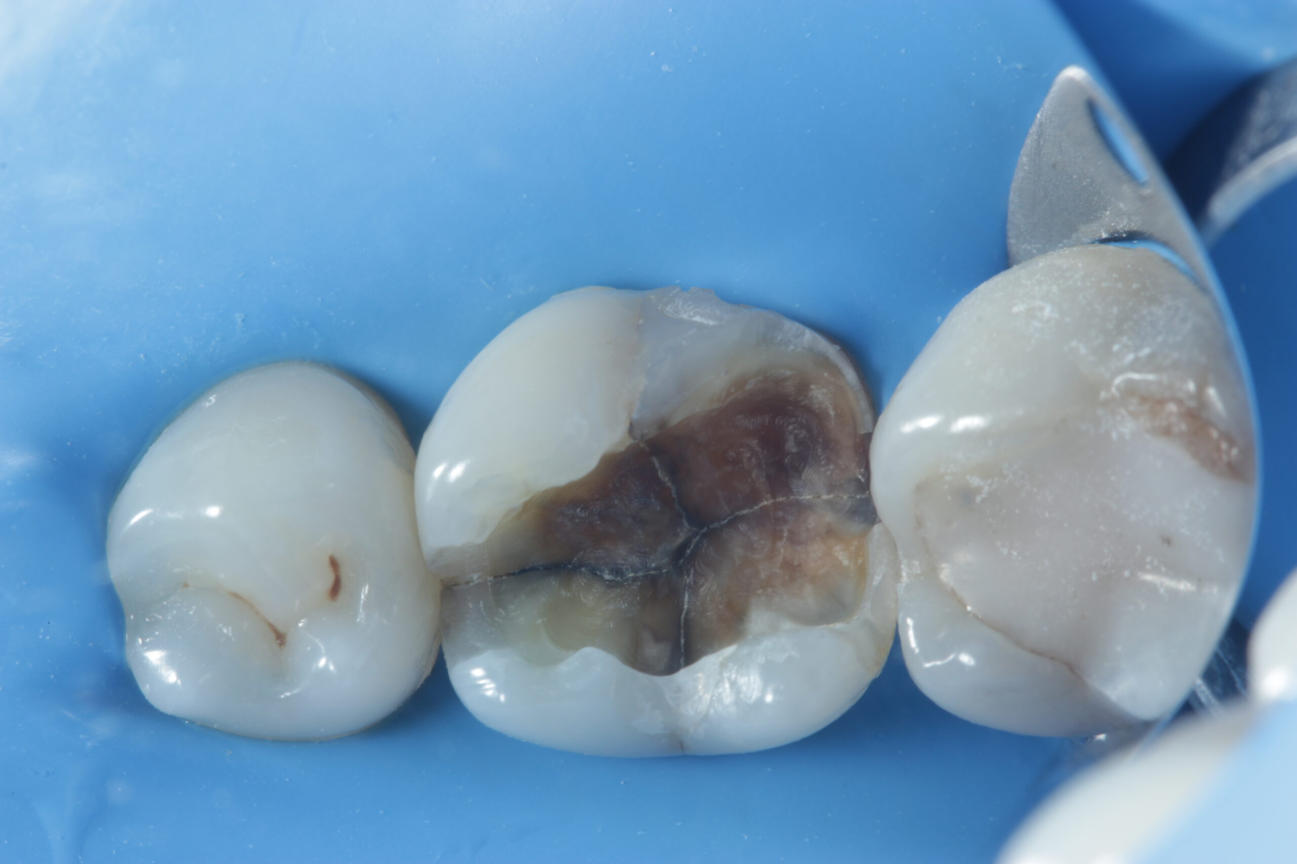 Dente trincado